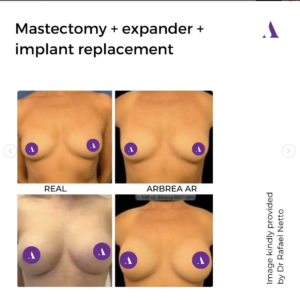 Breast reconstruction simulation in AI